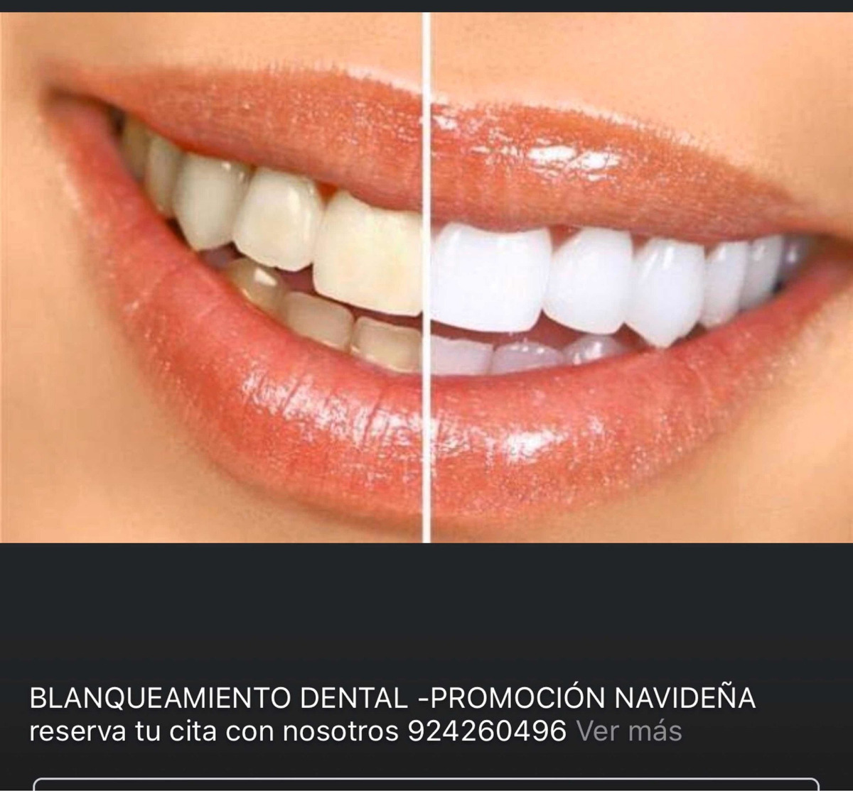 Blanqueamiento y limpieza dental