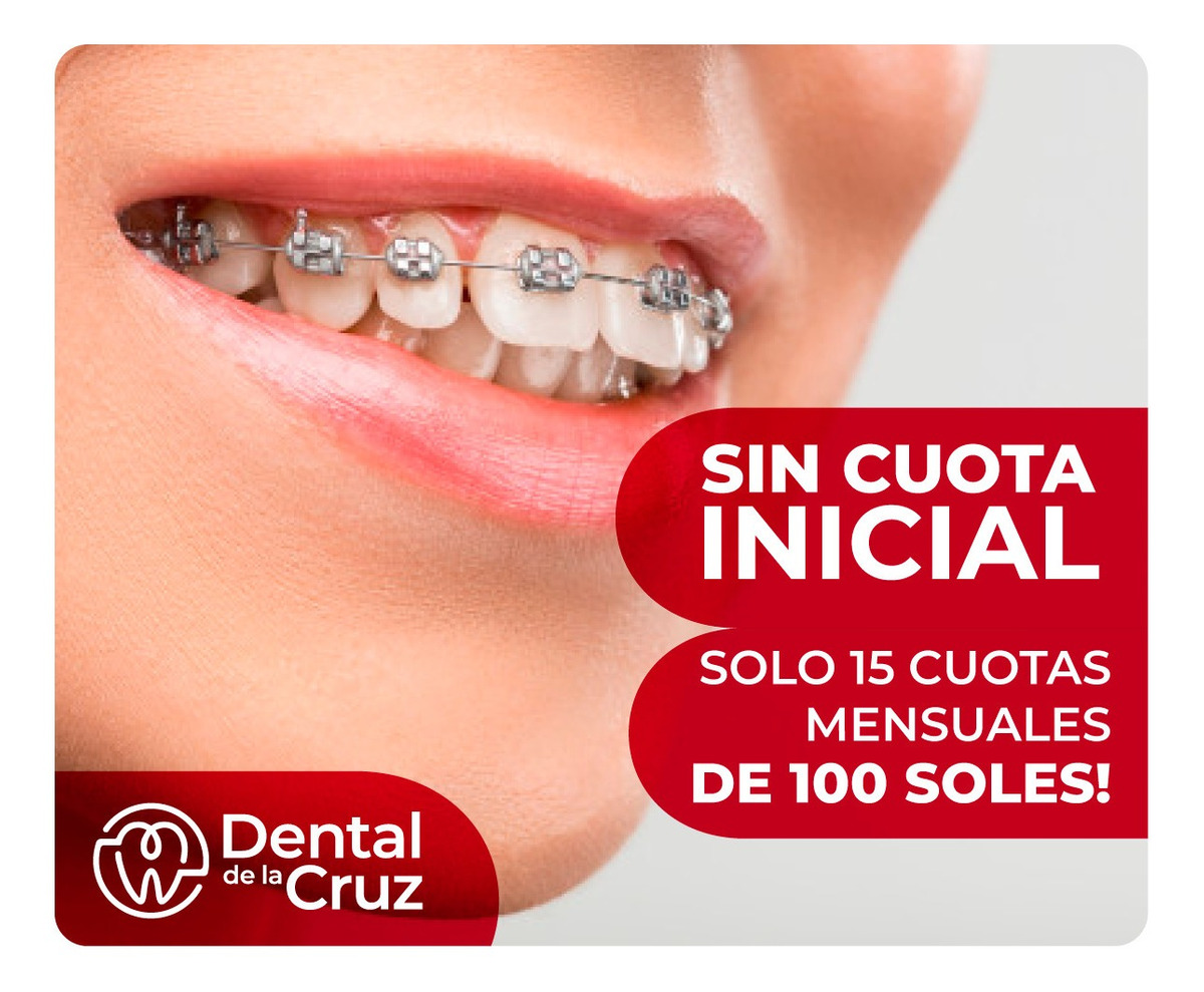 Brackets, ortodoncia, tratamiento ortodoncico sin inicial
