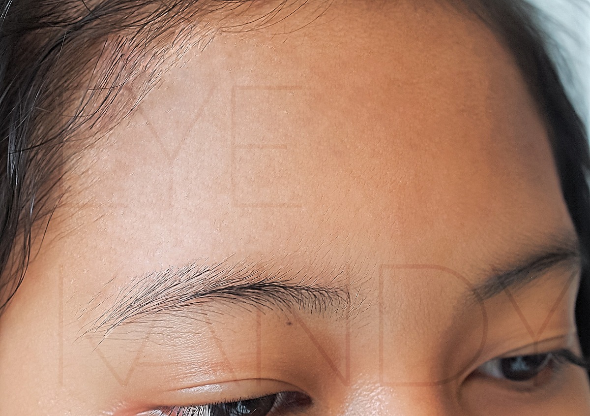 Microneedling (cit) terapia inducción de colágeno