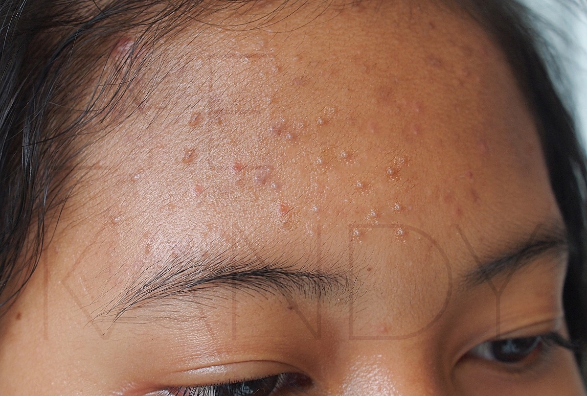 Microneedling (cit) terapia inducción de colágeno